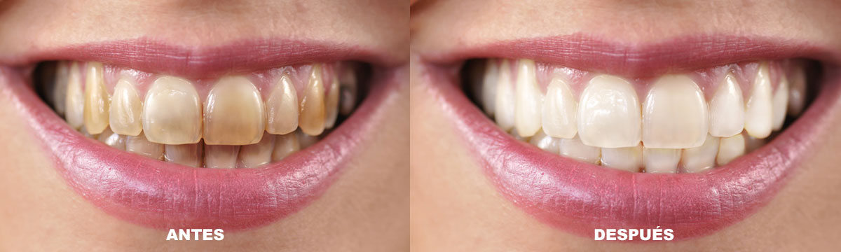 blanqueamiento dental en Medina del Campo