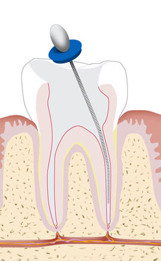 Endodoncias
