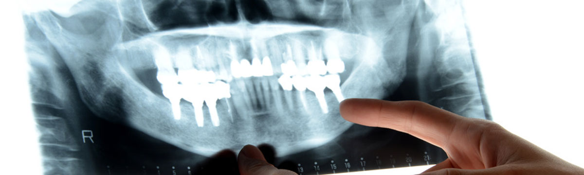implantes dentales en Medina del Campo