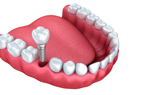 implantes Dentales